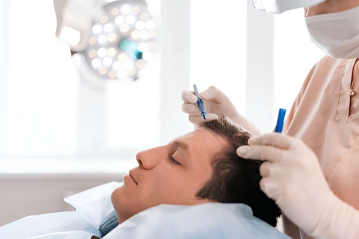 hair transplant UK