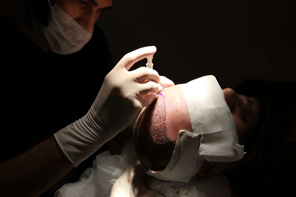 Hair Transplant