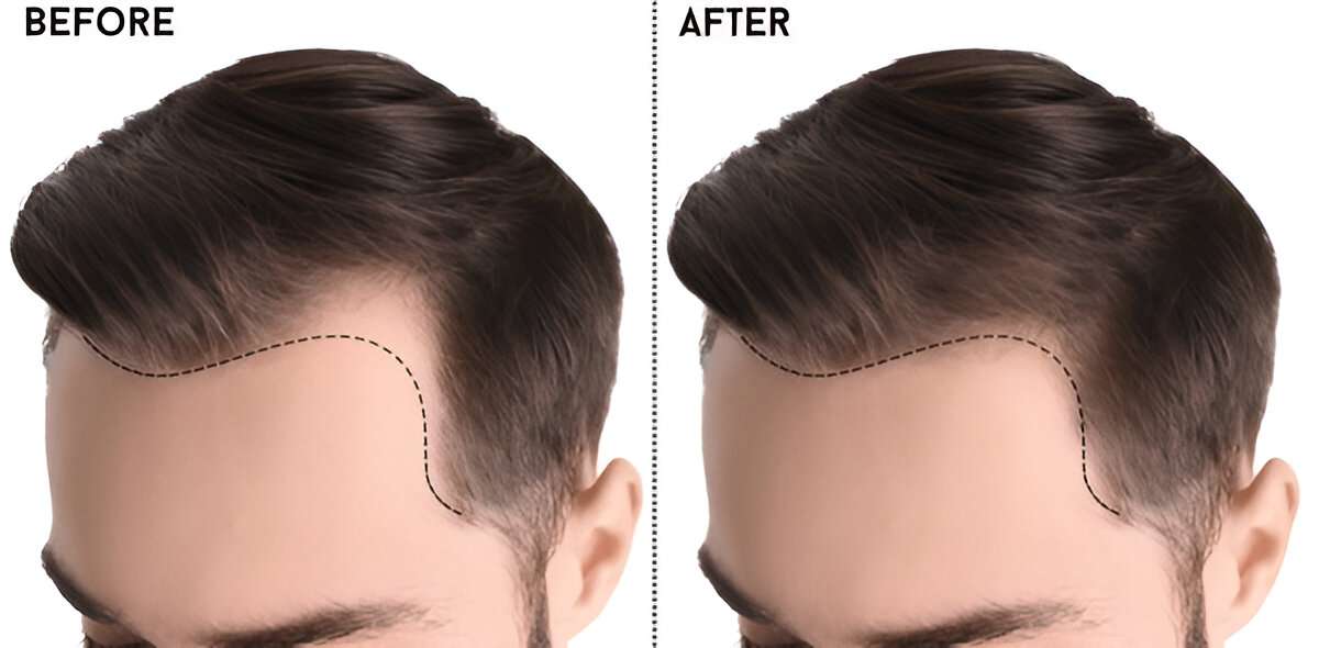 Hair Transplant