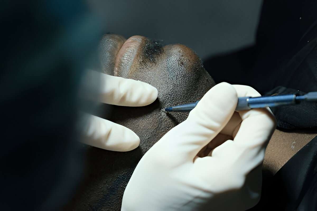 hair transplant Manchester