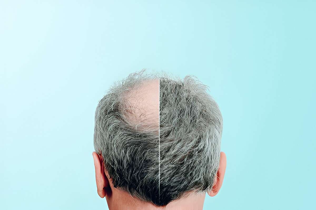 hair transplant Cardiff